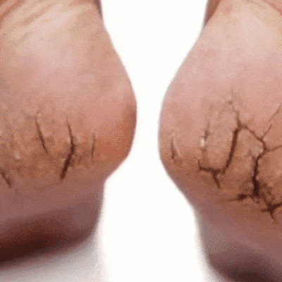 Gel Exfoliant pentru Călcâie