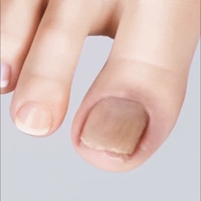 Plasturi pentru ciuperca unghiilor