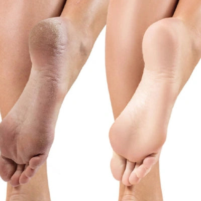 Gel Exfoliant pentru Călcâie Crăpate